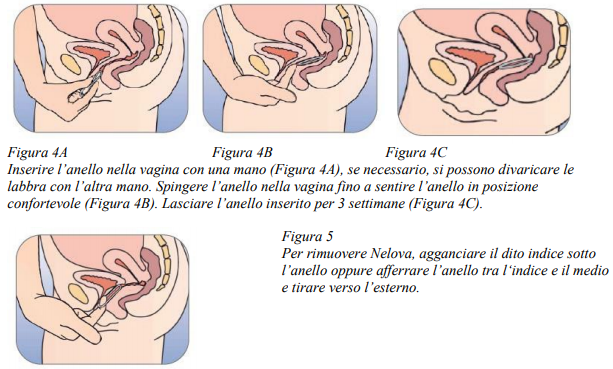 Anello anticoncezionale come hot sale si mette